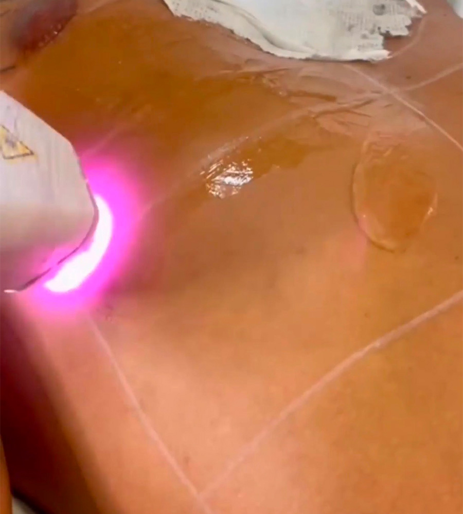 Depilação a Laser Diodo